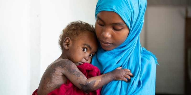 Halima ingresó en el centro nutricional acompañada de su madre Fatuma la segunda semana de febrero con Kwashiorkor.