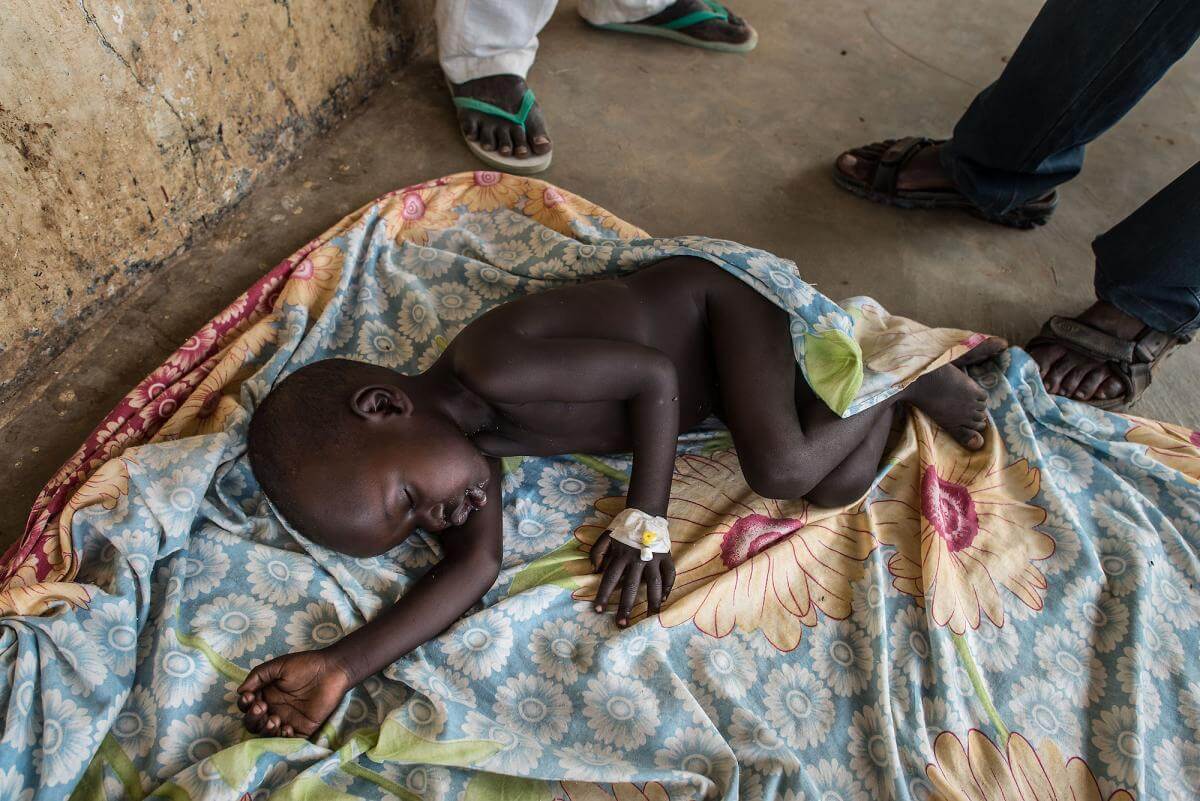 Este niño padece desnutrición y fue admitido en la OTP (Programa terapéutico para pacientes ambulatorios) de Malualbai, en Sudán del Sur.
