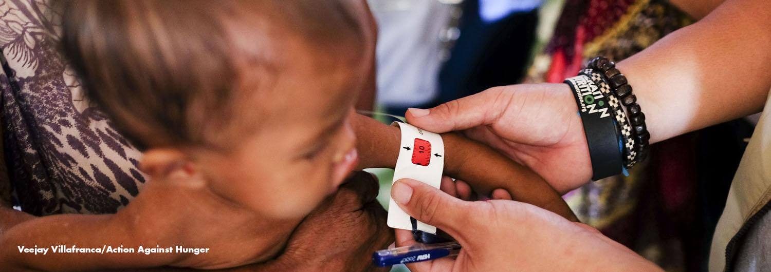 One in three Filipino under 5 children is stunted